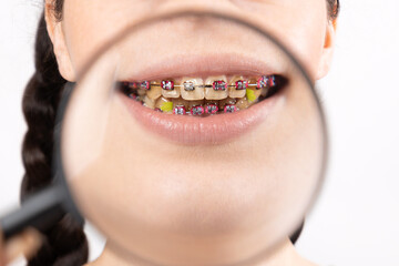 Close up of young Caucasian woman with brackets on dirty teeth. Zoomed view through magnified glass. Concept of dental care during orthodontic treatment