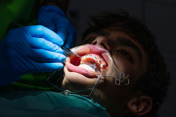 Teenage at the dental clinic putting bracket to correct teeth
