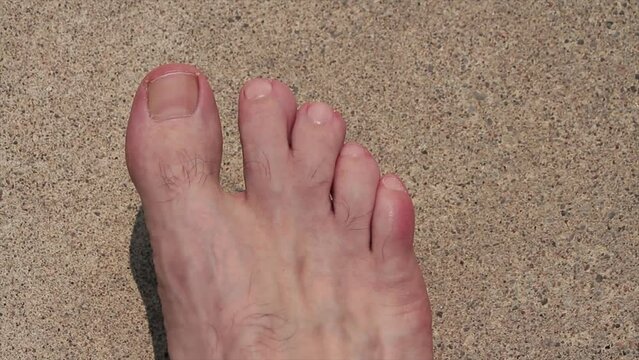 syndactyly between long second toe and middle third toe on adult male foot on pavement