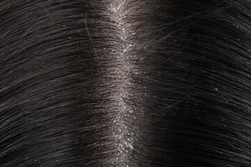 Closeup view of dark woman`s hair with dandruff