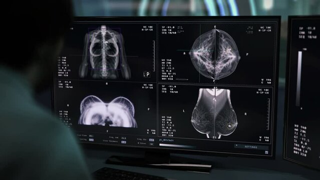 Medical Specialist Uses X-ray Screening Program To Examine Breasts Of Patient. Mammography X-ray Screening Checks For Diseases. Advanced X-ray Examination By Screening System. Healthcare