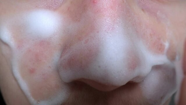 Teenage boy with acne problem washes face with foam cleanser close-up