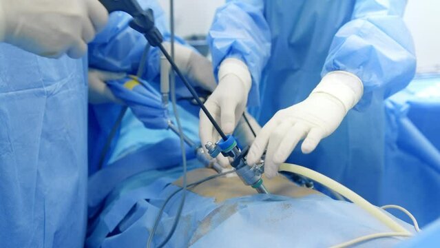This detailed video captures a live laparoscopic surgery being performed by skilled surgeons in a modern operating room. The medical team, dressed in sterile blue gowns and gloves, uses advanced lapar