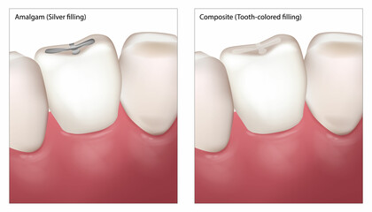 Dental Filling Procedure. Amalgam Silver filling and Composite Tooth colored filling. Dental restorations - obrazy, fototapety, plakaty