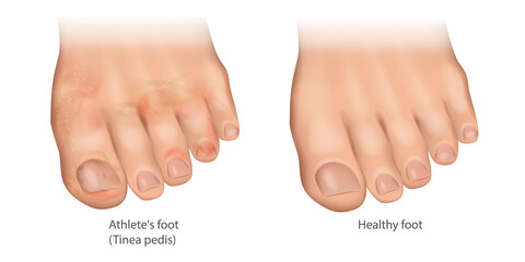 Illustration of the Athlete's foot and Healthy foot. Tinea pedis or ringworm of the foot, moccasin foot. Skin infection of the feet