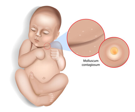 Molluscum contagiosum virus infection. Water warts. Molluscum contagiosum on the skin of an infant