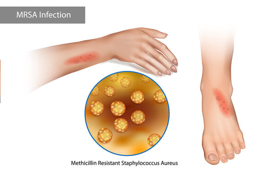 MRSA Superbug Infection. Methicillin Resistant Staphylococcus Aureus. Rashes on the arms and legs caused by staphylococcus