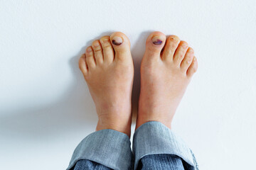 barefoot female feet with bruise on big toe nail due to tight uncomfortable shoes on white background - obrazy, fototapety, plakaty