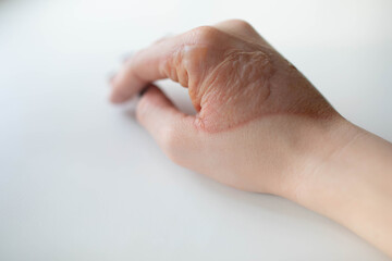 Hand with a burn from hot. Close-up.