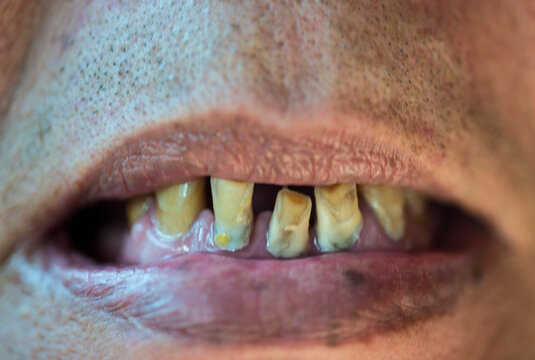 close up of a person with a teeth