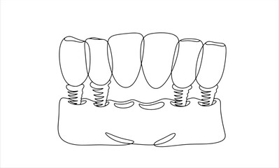 6 teeth. Dental bridge. One line © Anna