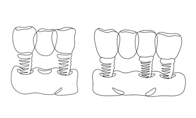 Dental bridge. Several teeth. One line © Anna