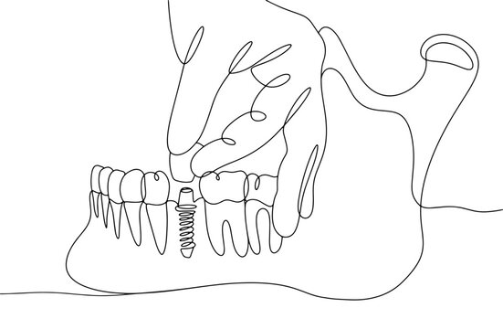 dental implant line art, teeth, jaw, hand clip art preview