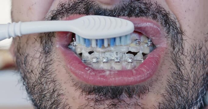 Cleaning metal braces with a toothbrush in longitudinal movements, shot close-up