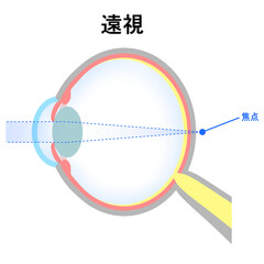 軸性遠視の眼球のイラスト