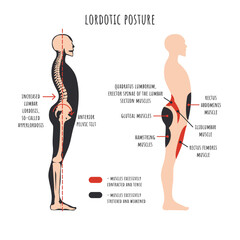 Posture disorders infographics. Lordotic posture. Side view shows hyperlordosis deformation, spine curvature, pelvis rotation, stretched and weakened, shortened and tens muscles. Vector illustration. - obrazy, fototapety, plakaty