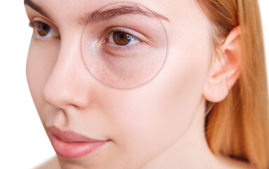 Young woman with bruises under eyes before and after treatment.