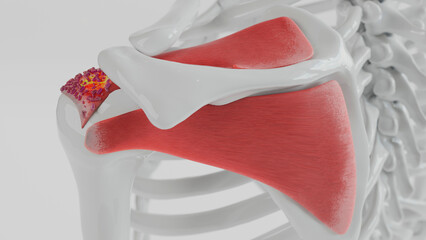 3D Rendering of Calcific Tendonitis in the Shoulder - obrazy, fototapety, plakaty