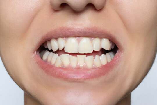 Young woman's smile before teeth straightening and whitening. Upper and lower jaw with crooked teeth before installation of veneers or braces. Close-up. Patient at a dental orthodontic clinic.