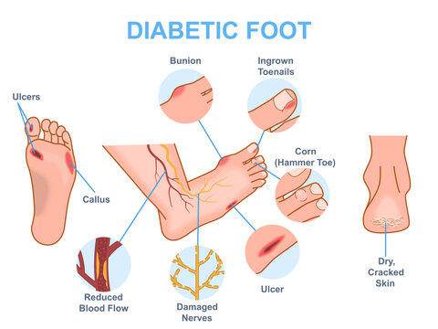 Diabetic foot medical diagram. Infographics with symptoms of diabetes and insulin resistance disease. Treatment and prevention. Cartoon flat vector illustration isolated on white background