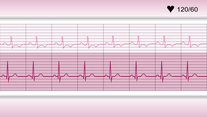 electrocardiogram