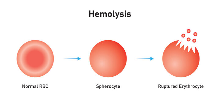 Hemolysis Process. The RBC Destruction Scientific Design. Vector Illustration.