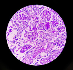 Photomicrograph: Meningioma, the most common type of primary brain tumor