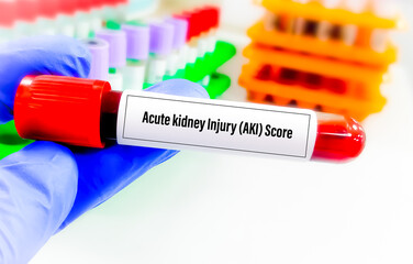 Blood sample for acute kidney injury (AKI) score test.