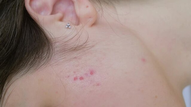 close up of the face of a young woman with problem skin red rashes, acne scars. Painful inflammation, adolescence, poor nutrition, hormonal imbalance, sensitive skin
