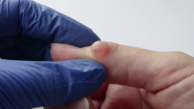 Doctor checkup a ganglion cyst on a finger, hygroma close-up.