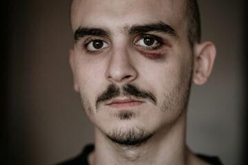 Fototapeta premium Injured young man with bruises on his face