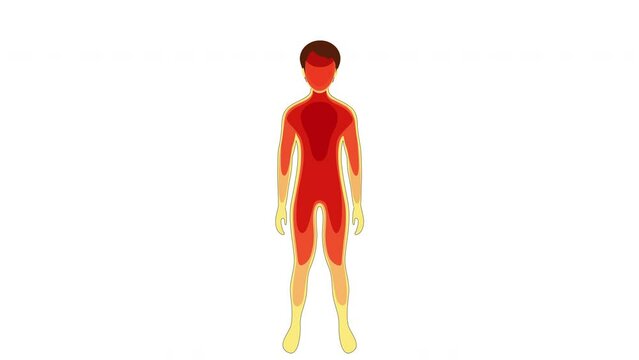 Hyperthermia. Changes in a  Body temperature during heat stroke. A thermal image showing temperature variation in a human body. failed thermoregulation. 2d 