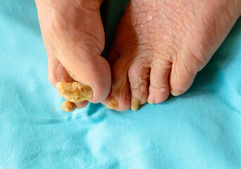 Onychomycosis, also known as tinea unguium, is a fungal infection of the nail.