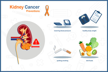 Medical vector illustration concept in flat style of kidney cancer. Kidney cancer prevention, quitting smoking,lowering blood pressure maintaining a healthy body weight,diet foods. - obrazy, fototapety, plakaty