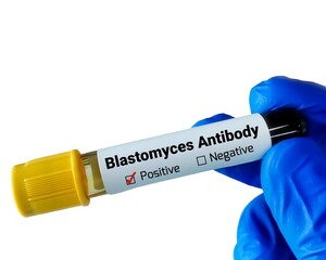 Blastomycosis is an infection caused by a fungus called Blastomyces. Blastomytes Antibody test