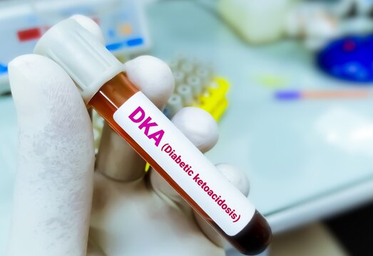 Blood sample for diabetic ketoacidosis (DKA) test. A complication of diabetes that can lead to a coma or even death.