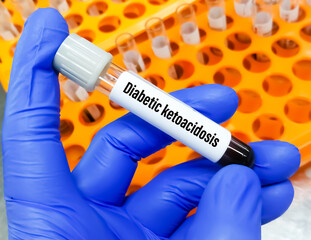 Blood sample for diabetic ketoacidosis (DKA) test. A complication of diabetes that can lead to a...