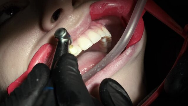 The orthodontist removes the remaining material from the patient's teeth after removing the braces. Grinding of teeth.