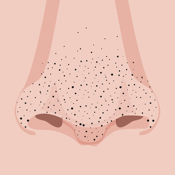 Front of the face nose with blackheads or black dots or acne pimples, illustration close-up
