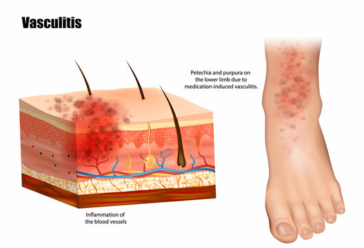 Vasculitis involves inflammation blood vessels. Petechia and purpura on the lower limb due to medication-induced vasculitis. Lymphangitis