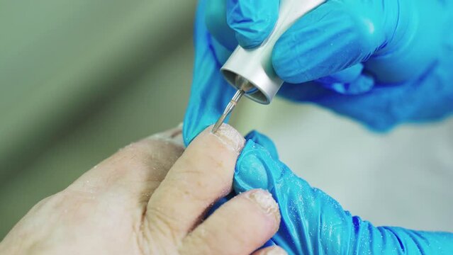 Treatment of toenails. An orthopedic doctor treats toenails for a fungal infection. Close-up.