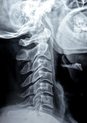 Plain X ray of cervical spine revealed straightened cervical curve, spondylosis osteophytic lipping...