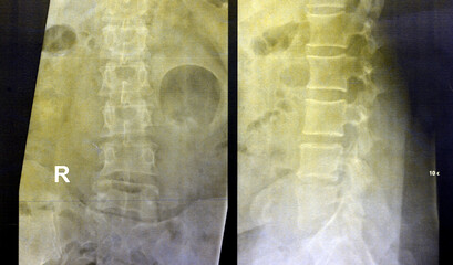 Plain X ray lumbosacral spine revealed straightened, mild scoliotic deformity of  lumber spine,...