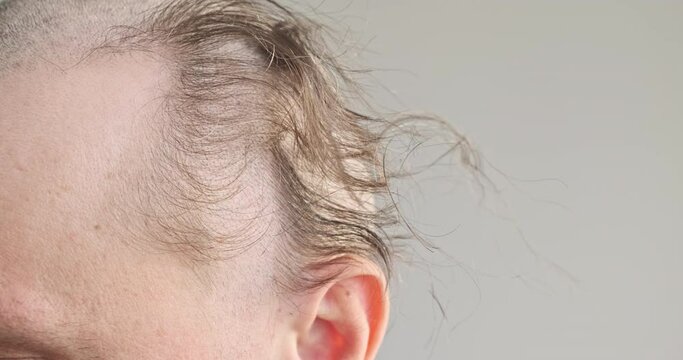 Caucasian man shaves bald temple with hair clipper. Top view. Short haircut man head, close up. Male haircut electric razor