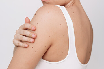 Cropped shot of a young woman with a large number of moles isolated on a white background. The...