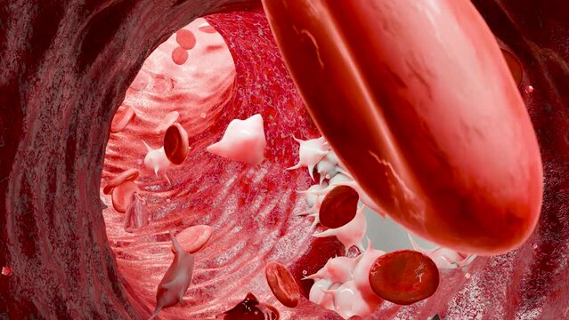 Hemostasis. Red blood cells and platelets in the blood vessel,  vasoconstriction, wound healing process. hemorrhage clot embolisms, Hemophilia. fibrinolysis, injury bleeding coagulation, 3d render
