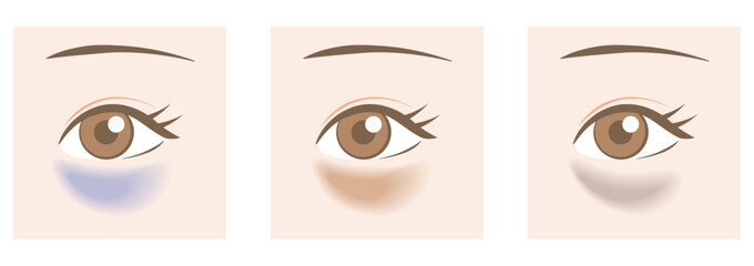 目のクマの種類