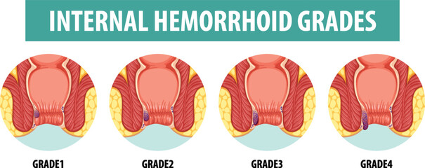 Anatomy of Human Internal Hemorrhoid in Different Grades - obrazy, fototapety, plakaty