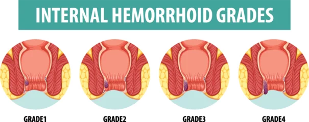 Acrylic prints Kids Anatomy of Human Internal Hemorrhoid in Different Grades