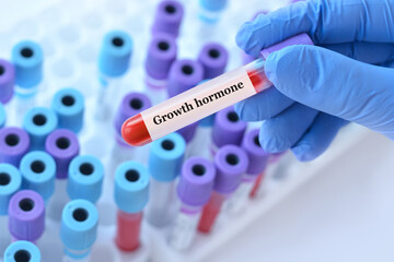 Doctor holding a test blood sample tube with Growth hormone test  on the background of medical test tubes with analyzes